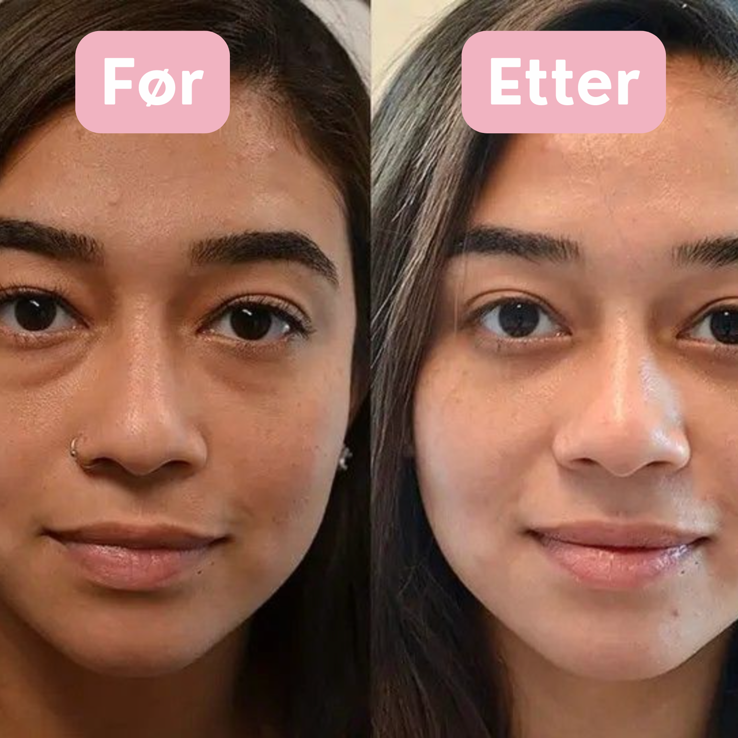 Microneedle Øyepatcher av Eterna